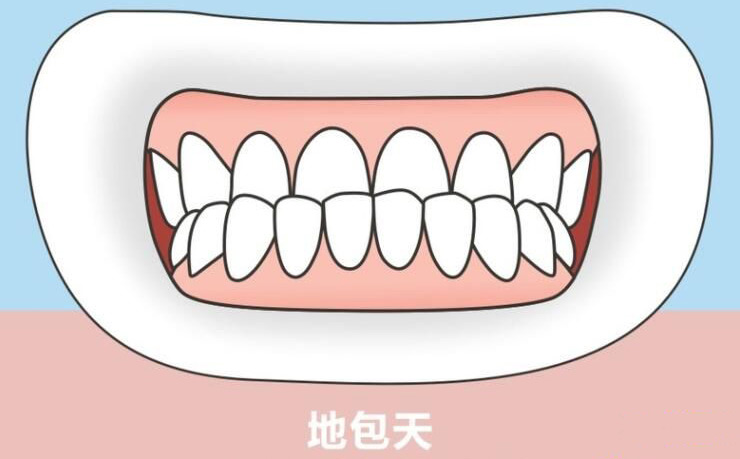 如果孩子有“地包天”，該怎么辦？